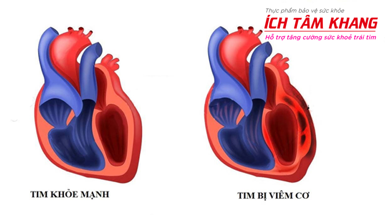 Bị viêm cơ tim có thể chẩn đoán bằng nhiều phương pháp khác nhau